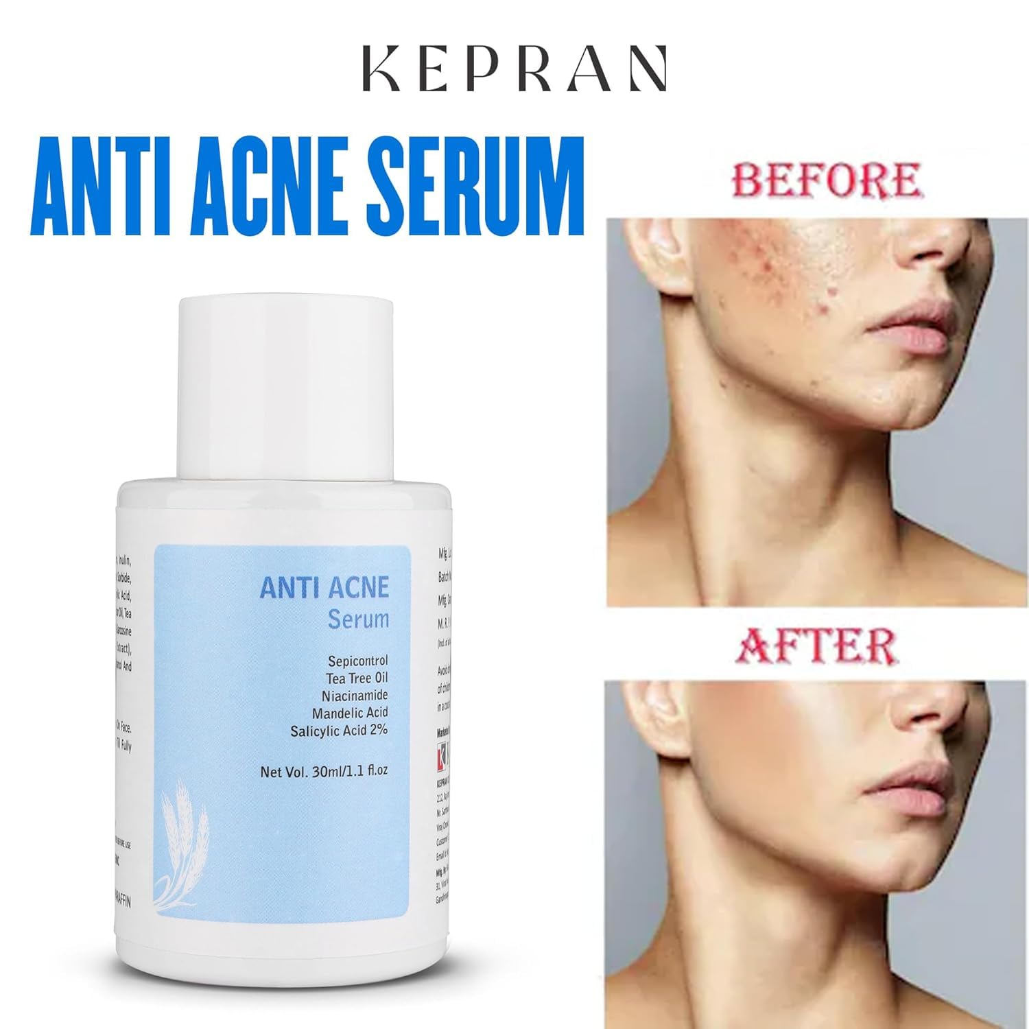 Anti Acne Serum with Tea Tree Oil, Niacinamide, Mandelic Acid, Salicylic Acid 2%, 30ml